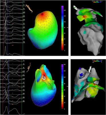 Performance and Robustness Testing of a Non-Invasive Mapping System for Ventricular Arrhythmias